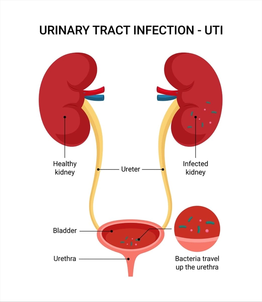 How UTIs can be treated through telemedicine
