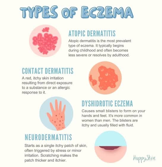 Eczema (Atopic Dermatitis): Symptoms, Causes, Treatment, and Skin Care